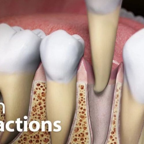 Tooth Extractions