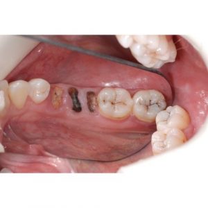 Tooth Extractions - World Smiles Dental Center