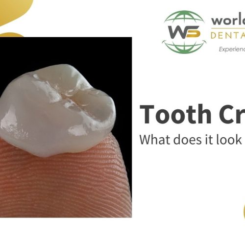 What does a tooth crown look like