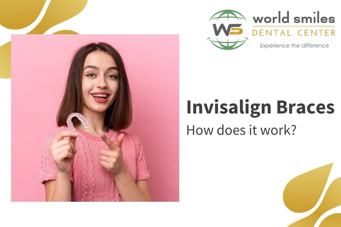 How Invisalign Braces Work
